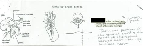 1015 Spina Bifida Pictures Flashcards Quizlet