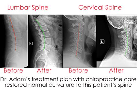 X Ray Before And After Chiropractic Care Dr Adam J Friedman