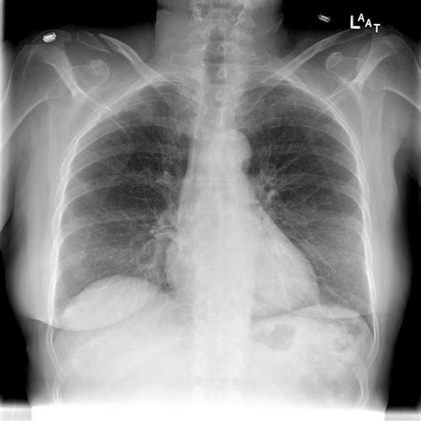 Interpreting A Chest X Ray Stepwards