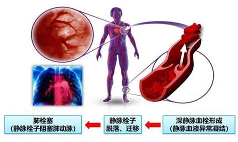 深静脉血栓科普系列一浙江海创医疗器械有限公司