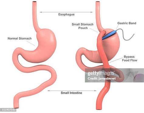 Gastric Bypass Surgery Photos And Premium High Res Pictures Getty Images