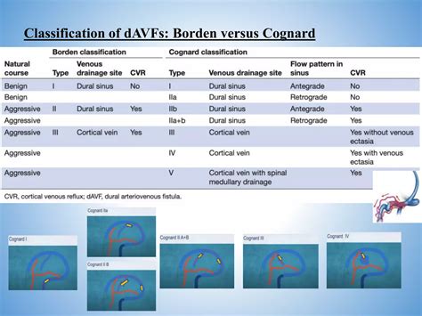 Dural Arteriovenous Fistula Pptx