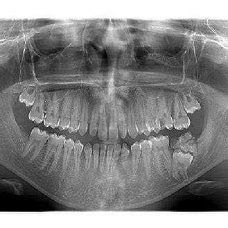 Orthopantomograph Showing Radiopaque Structure With Impacted Mandibular