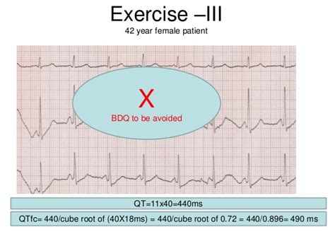 Excercise corrected qt interval (q tc) ecg interpretation