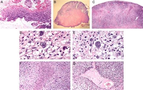 Histopathologic Features Of An Epstein Barr Virus Ebv Mucocutaneous