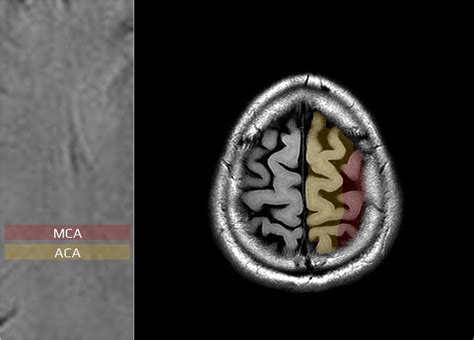 Arterial Territories Of The Brain Stroke Manual