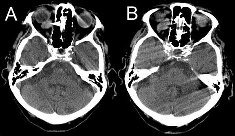 Orbital Varix In A Year Old Female Contiguous Contrast Enhanced Ct