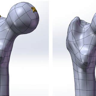 Three-dimensional trochanteric fracture cut-out model | Download ...