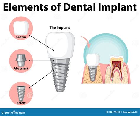 Infographic Of Human In Structure Of The Dental Implant Stock Vector