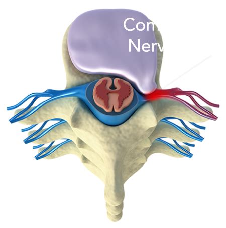 Herniated Disc Radiculopathy