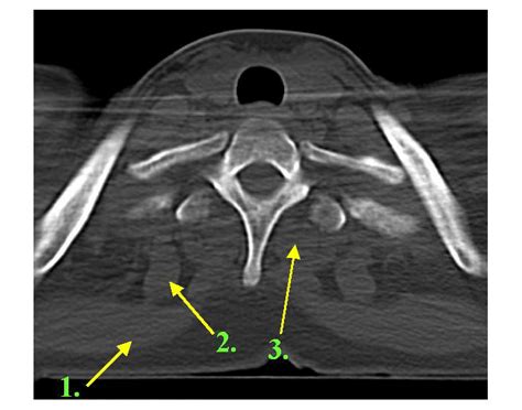 Muscles of the Spine Cervical Quiz