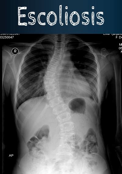 ¿qué Es La Escoliosis Lumbar Dolor De Espalda Y Cuello