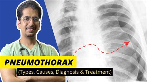 PNEUMOTHORAX Types Causes Diagnosis Treatment Detailed Video