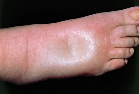 Edema Dermatology Conditions And Treatments