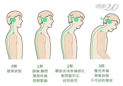 頸椎比你想得還脆弱！32個習以為常的動作，都是加速退化的幫凶頸椎退化頸椎病林頌凱｜健康20