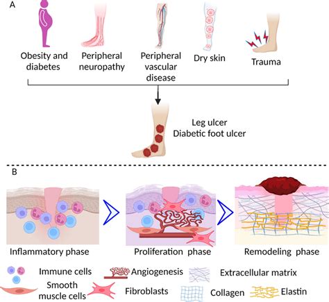 Risk Factors And Wound Healing In Diabetic Foot Ulcer Dfu Showing A