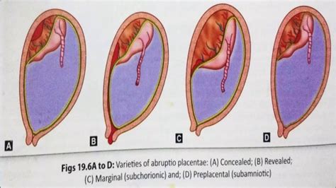 Antepartum Haemorrhage Aph Cause And Management Vaidyaनमः