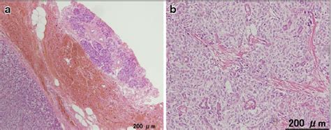 Microscopic Findings Of The Tumor A The Borderline Between The Tumor