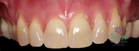 Gum Recession Synergy Periodontics And Implants Virginia