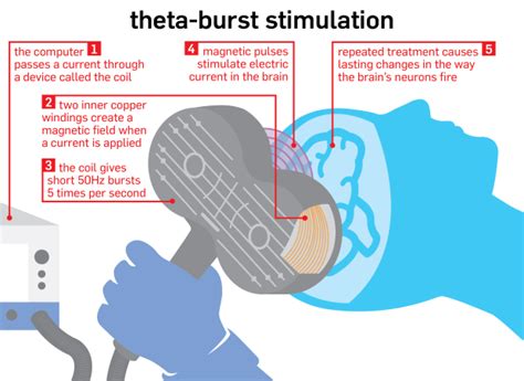 What Is Tbs Theta Burst Stimulation Tms Center Of Ventura