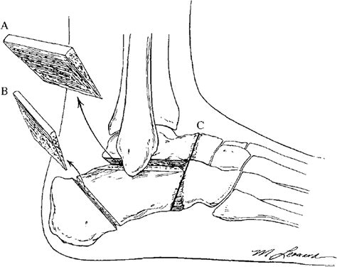 Management Of The Malunited Triple Arthrodesis Foot And Ankle Clinics