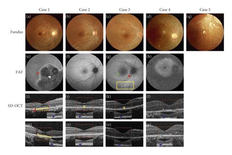 Fundus Photography Fundus Autofluorescence Imaging And Foveal Optical