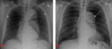 Thoracic Aortic Aneurysms - Clinical Features - Management - TeachMeSurgery