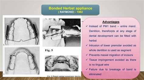 Fixed Functional Appliances Ppt