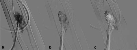 A Typical Case Of Dsa Guided Sclerotherapy A Needle Placed In The