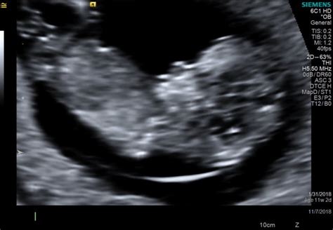 11 week ultrasound | BabyCenter