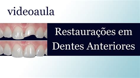 Aula Dent Stica Restaura Es Em Dentes Anteriores Youtube