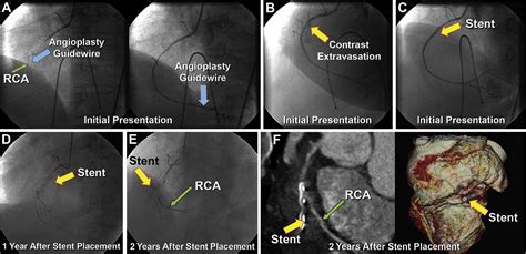 JACC Journals On Twitter JACCCaseReports Quiz Answer Stent