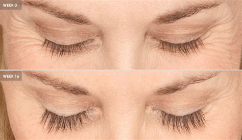 Latisse Eyelash Serum Joseph Eye And Laser