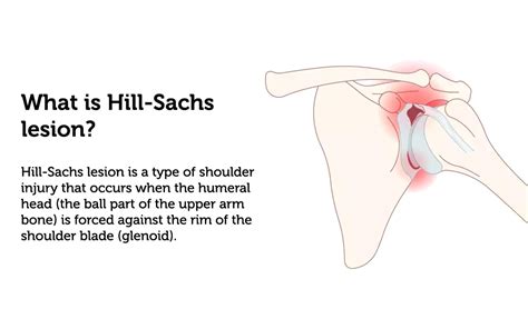 The Role Of Physiotherapy In Managing Hill Sachs Lesions