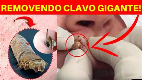 Cravos E Espinha Gigante - Retirando cravo gigante, como eliminar espinhas, como acabar com as ...