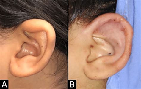 A Preoperative Appearance B Immediate Postoperative Appearance