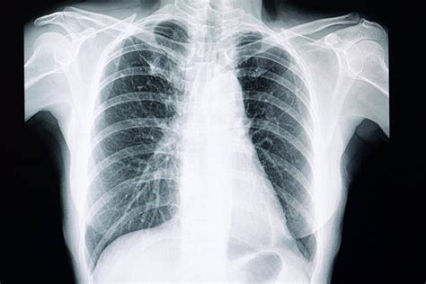 La Ia Identifica Con Precisión Las Radiografías De Tórax Normales Y