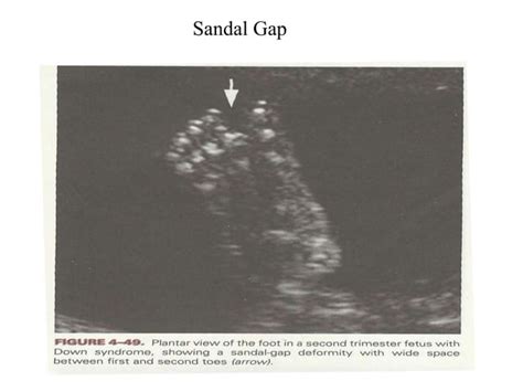 Genetic Sonogram And Soft Tissue Markers