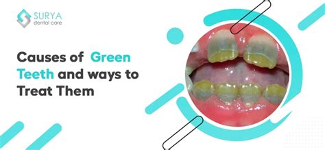 Causes Of Green Teeth and Way To Treat Them
