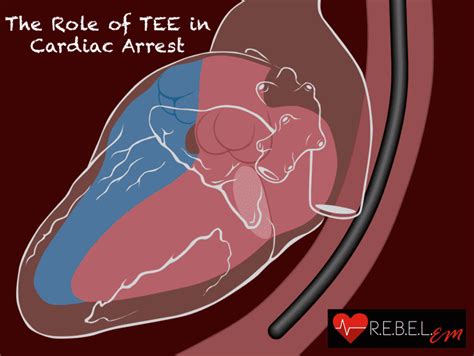 The Role of TEE in Cardiac Arrest - REBEL EM - Emergency Medicine Blog