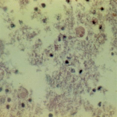 (PDF) Fulminant amoebic colitis with cecal pneumatosis