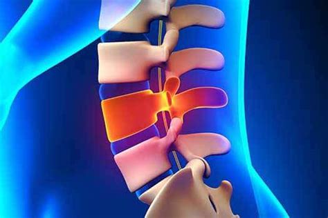 Spinal Fracture Causes, Symptoms, and Treatments