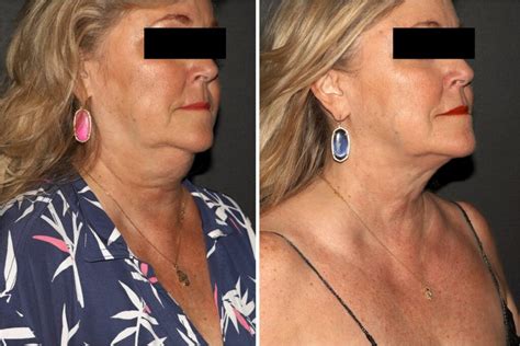 Coolsculpting® Chin Fat Results Before And After San Antonio And Boerne