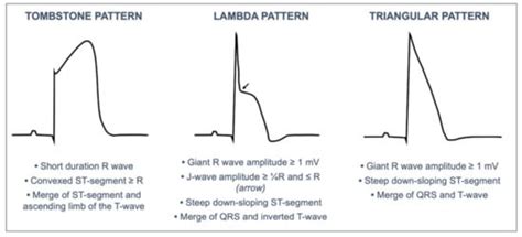 T Wave Elevation