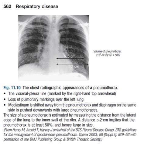 Pneumothorax Flashcards Quizlet