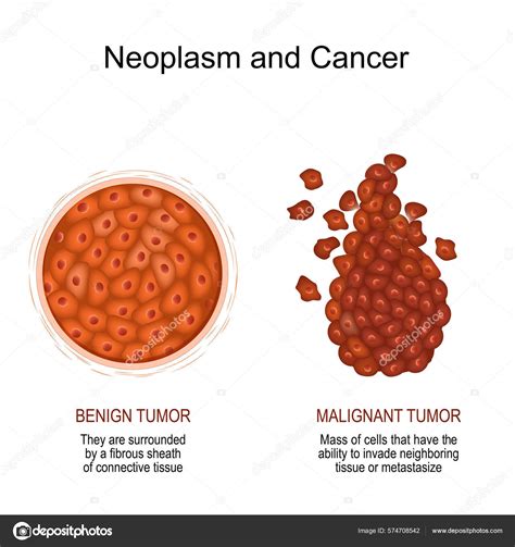 Tumeur Cancer Comparaison Différence D une Tumeur Maligne Bénigne