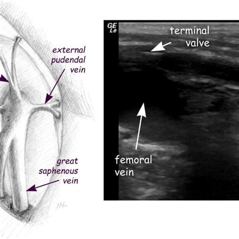 0. Great saphenous vein and its tributaries | Download Scientific Diagram