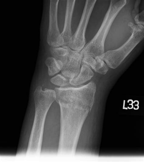 Hutchinson Fracture