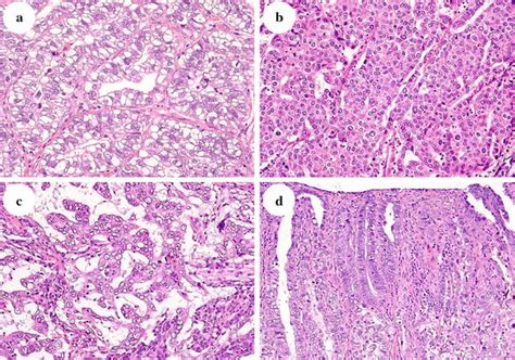 Clinicopathologic And Immunohistochemical Characteristics Of Gastric Adenocarcinoma With