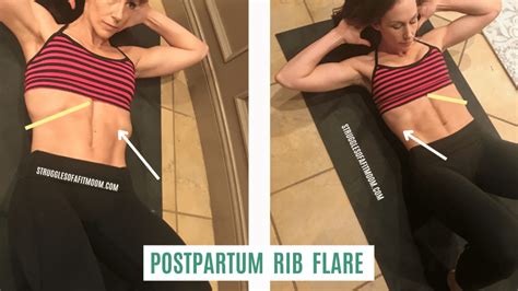 Correcting Rib Flare The Sneaky Saboteur Of Your Flat Tummy